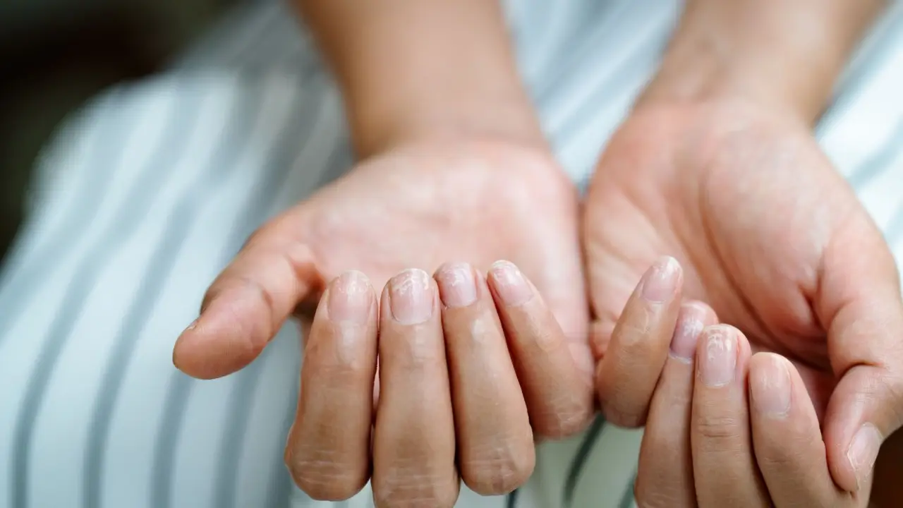 ¿Dolor o rigidez en las manos? Cuidado con estos primeros síntomas de artritis