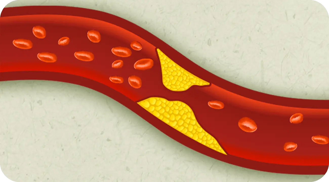 La enfermedad de los tres vasos: el grave problema cardíaco que casi no da síntomas hasta el infarto